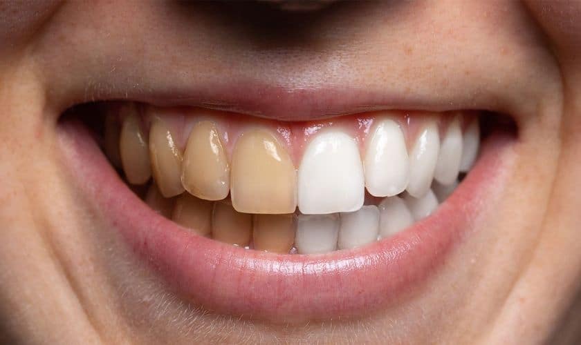 5 Easy Ways to Get Rid of Coffee Stains on Your Teeth