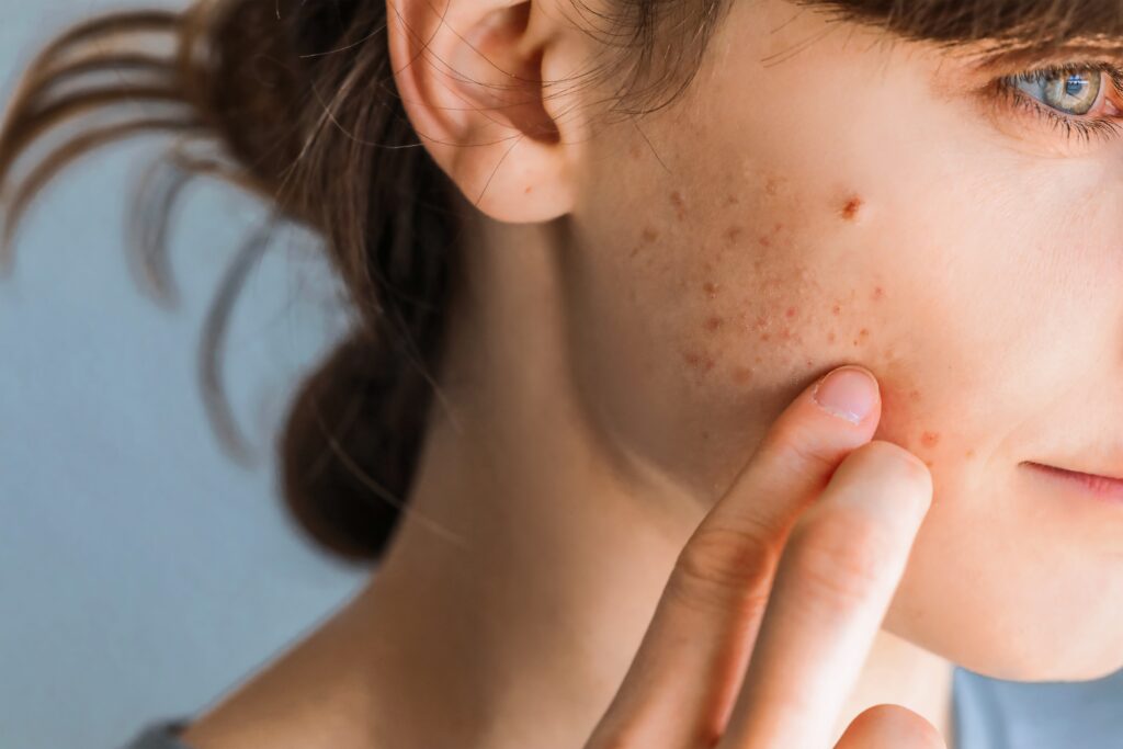 Adult Acne: Tips and Tricks to Managing your Skin in Australia - Insider  Guides