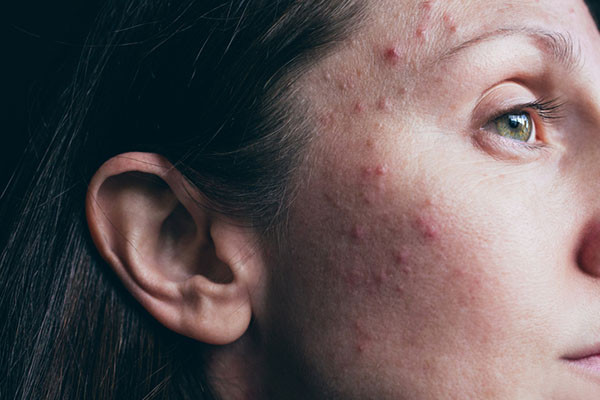 Adult female acne: Why it happens and the emotional toll - Harvard Health